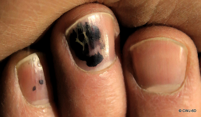 Don't bother with black nail varnish, just jam your fingers in a well-sprung fire-door as it slams shut!