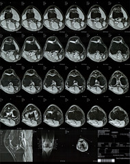 MRI scans of right knee 5/5