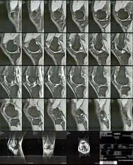 MRI scans of right knee 1/5