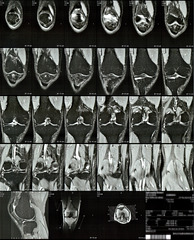 MRI scans of right knee 4/5