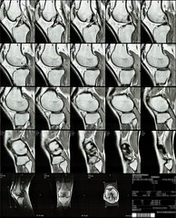 MRI scans of right knee 3/5