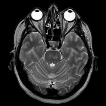 bilateral pontine lesions bilateral pontine lesions