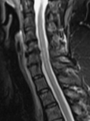 C6 spinal cord lesion