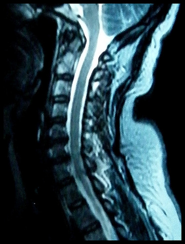 C6 spinal cord lesion (sagittal)