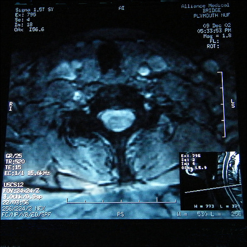 C6 lesion (axial 4 0f 5)