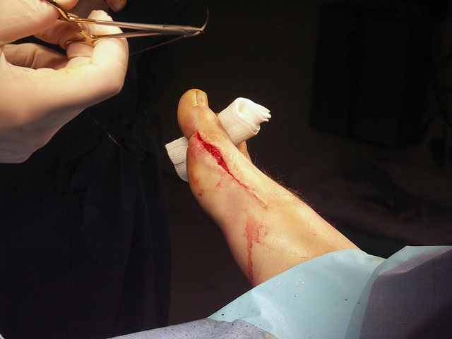 Suture 2