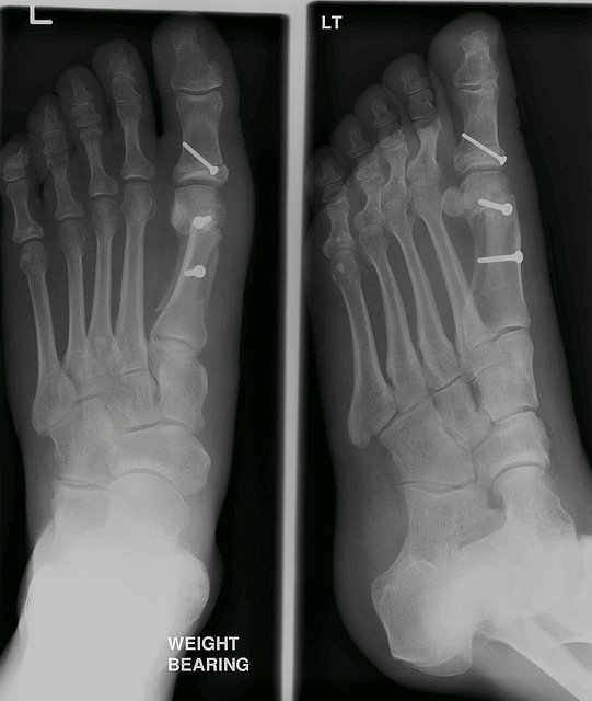 Left Foot, 2 weeks post-op