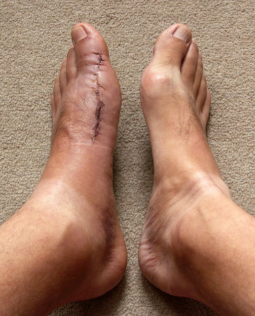 10 Days After Surgery