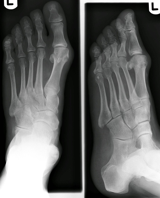 Left Foot pre-op