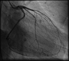 Angiogram