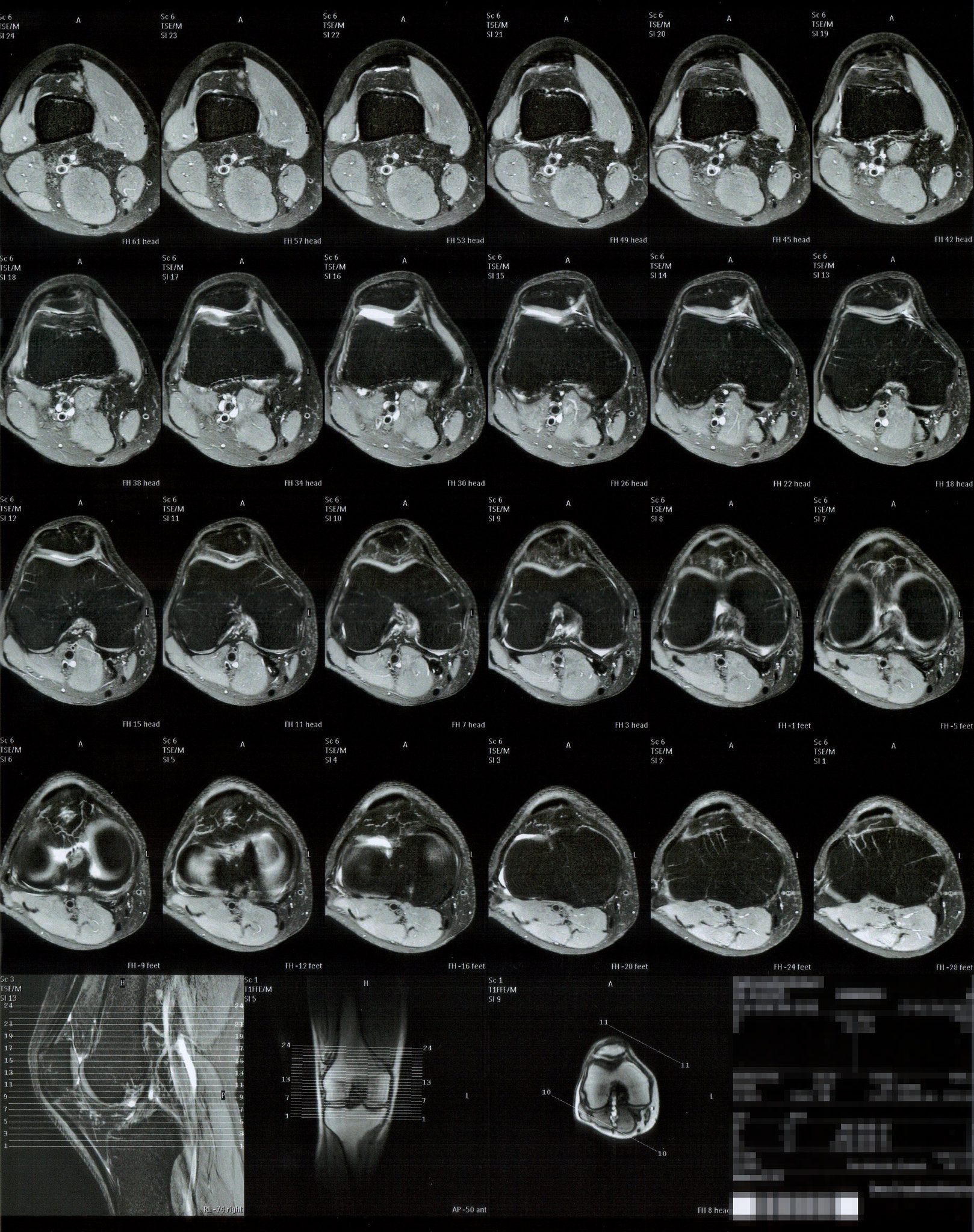 MRI scans of right knee 5/5