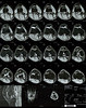 MRI scans of right knee 5/5