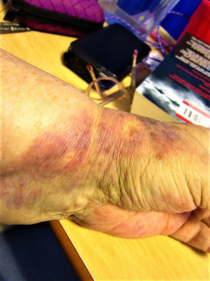 These are the  bruises left over from blood tests and blood pressure!!!!