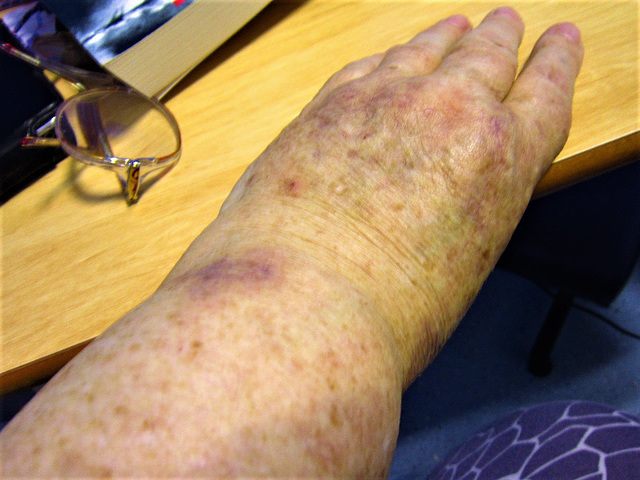 More bruises where tiny needles were pushed in to find out how many veins/arteries had a lot of oxygen in them