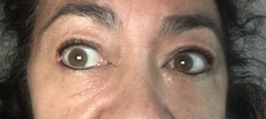 eyes after third treatment