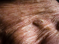 Warts and All