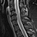 C6 spinal cord lesion