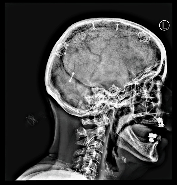 11 THE HARDWARE IN MY SKULL 11 THE HARDWARE IN MY SKULL