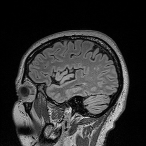 sagittal brain scan