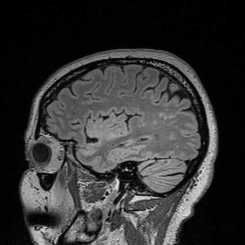 sagittal brain scan