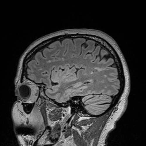 sagittal brain scan