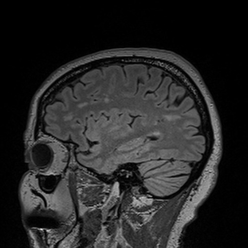 sagittal brain scan