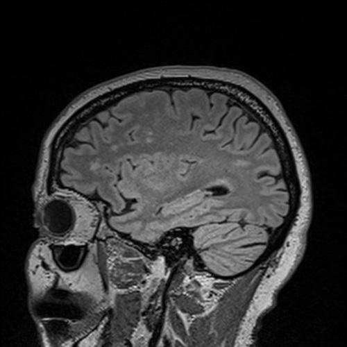 sagittal brain scan