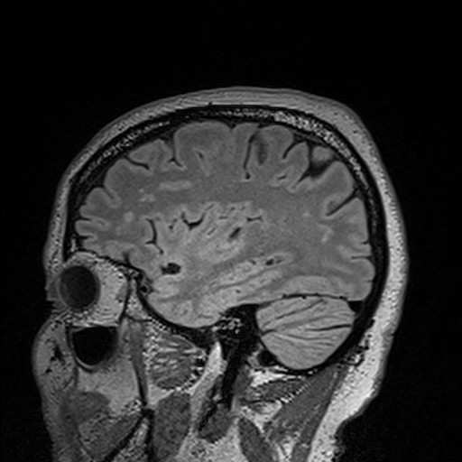 sagittal brain scan