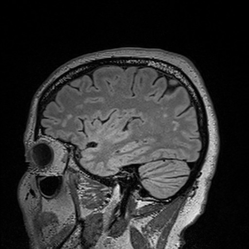 sagittal brain scan