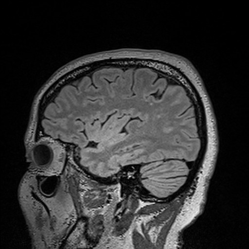 sagittal brain scan