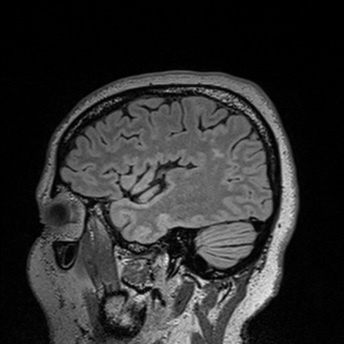 sagittal brain scan